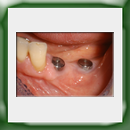 Ponte in lega aurea e ceramica su impiantii-4A